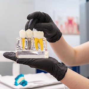 dental implant model in a dentist’s hand