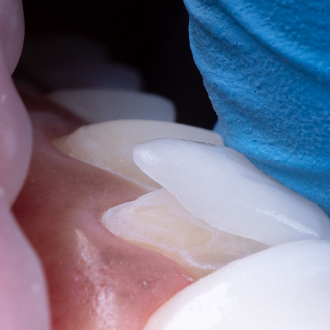 Close-up of veneer being attached to tooth