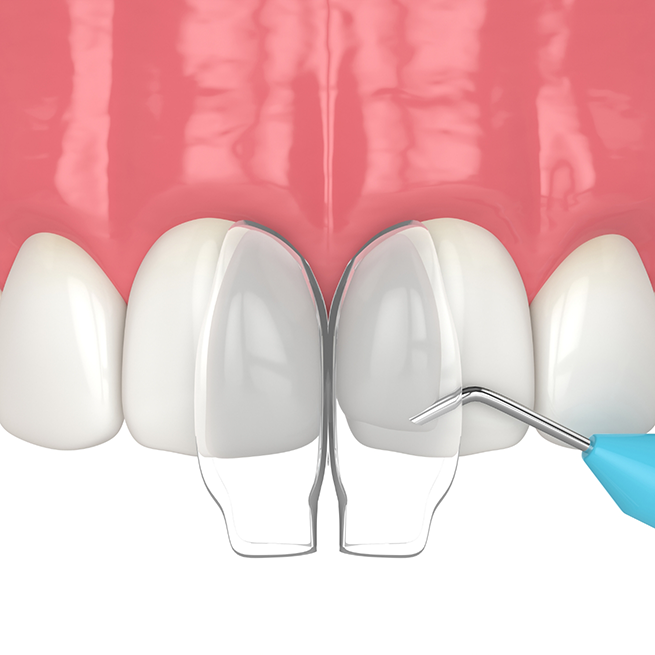 Illustration of cosmetic bonding being performed on upper teeth