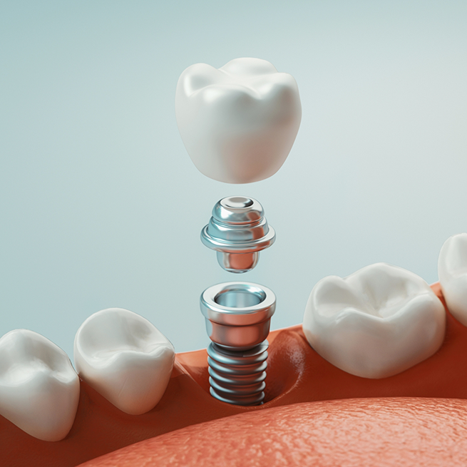 Illustration of dental implant in Bloomfield with abutment and crown