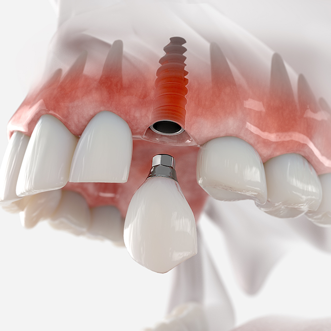 Illustration of crown being attached to dental implant in upper jaw