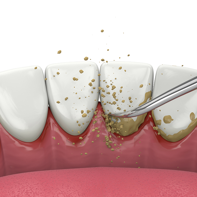 Illustration of scaling and root planing performed on lower teeth