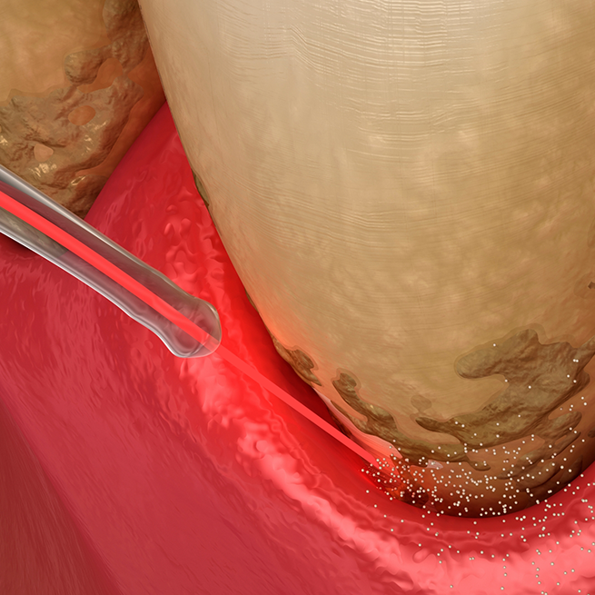 Illustration of laser used for gum disease treatment in Bloomfield