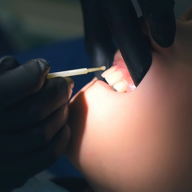 Fluoride treatment being applied to the upper teeth