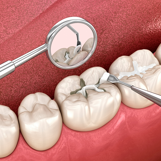 Illustration of tooth-colored filling being applied to tooth