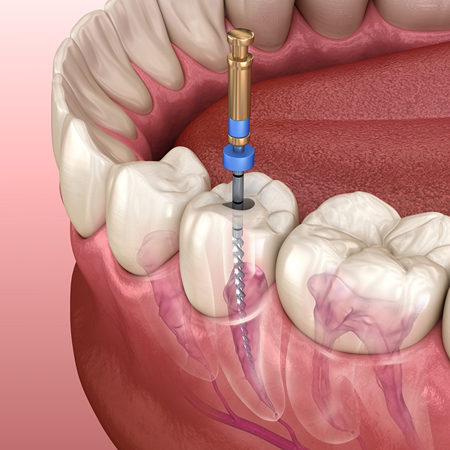 Illustration of root canal treatment in Bloomfield performed on tooth in lower arch