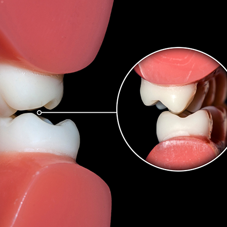 Close-up of teeth showing how they make contact