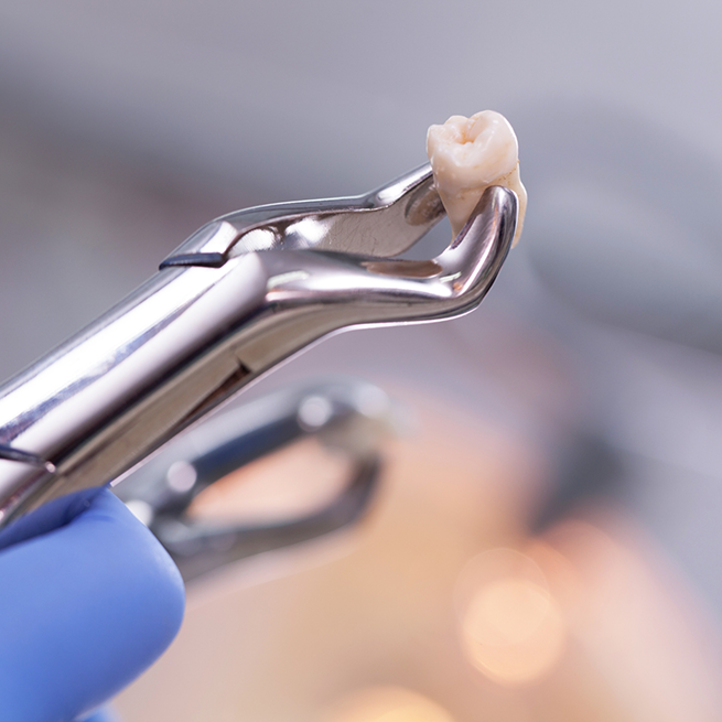 Close-up of gloved hand holding extracted tooth in forceps